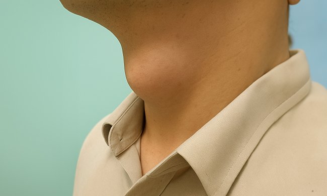 Cirurgia para Cistos Tireoglosso, Branquial e Dermoide