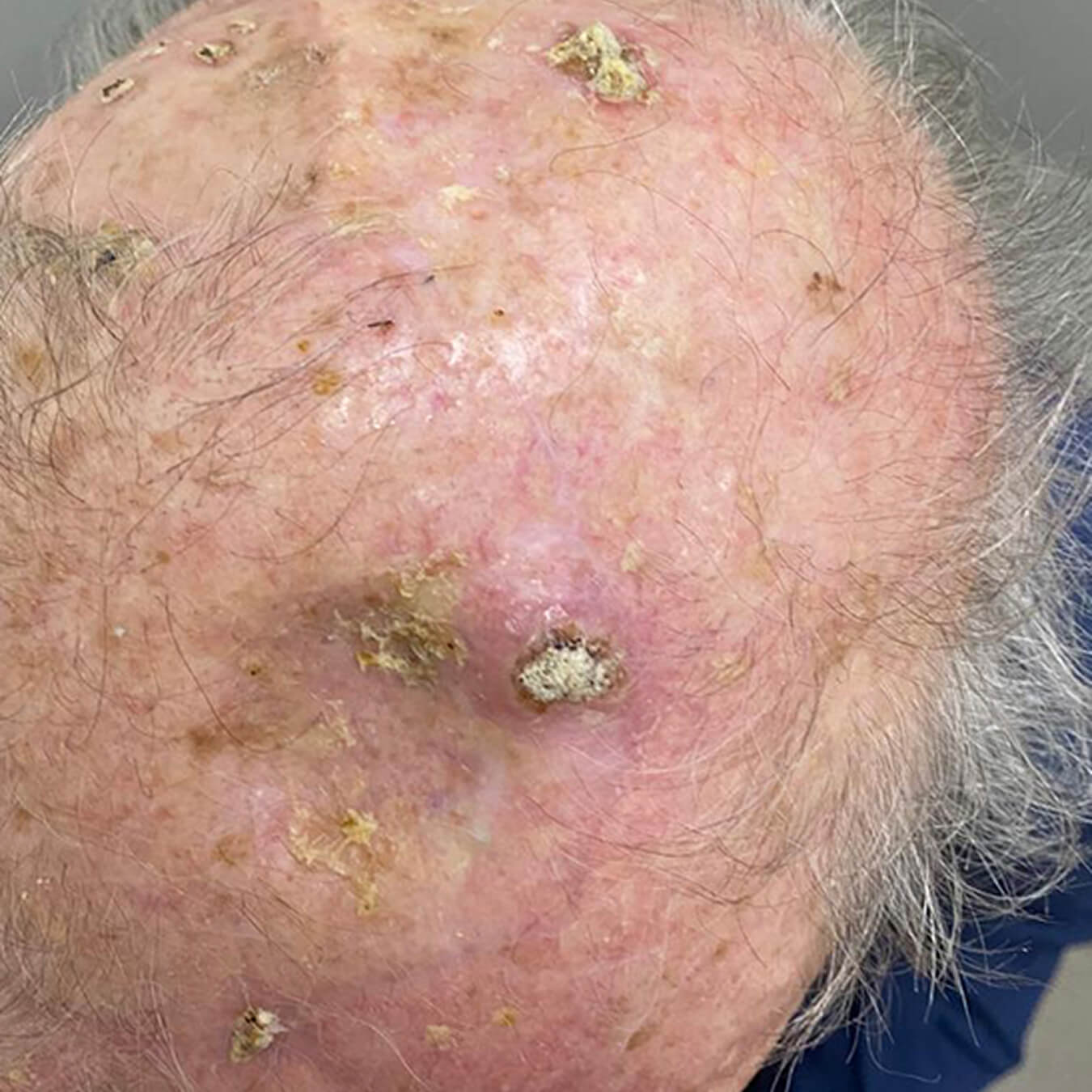 Carcinoma basocelular em região frontal direita