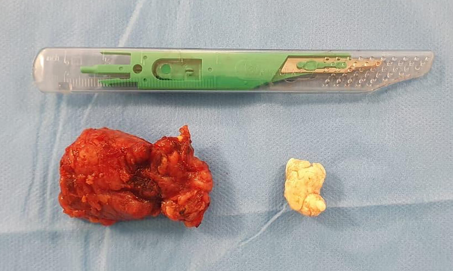 Glândula submandibular com inflamação crônica associada a calculo volumoso